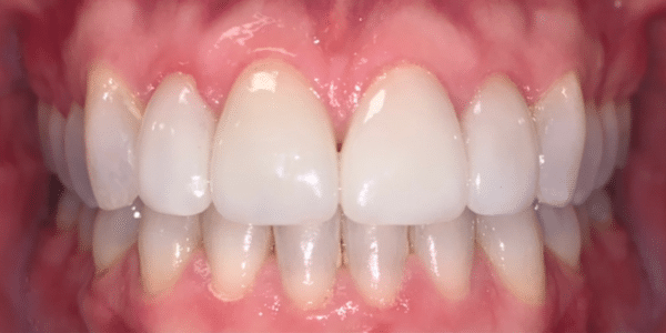 Dental Crowns After