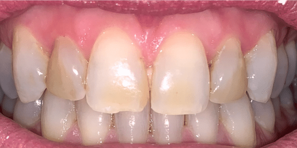 Dental Crowns Before
