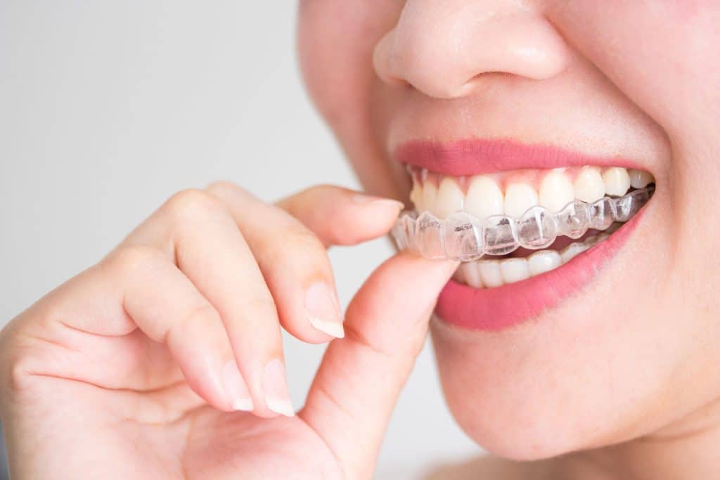 women with clear aligners smiling
