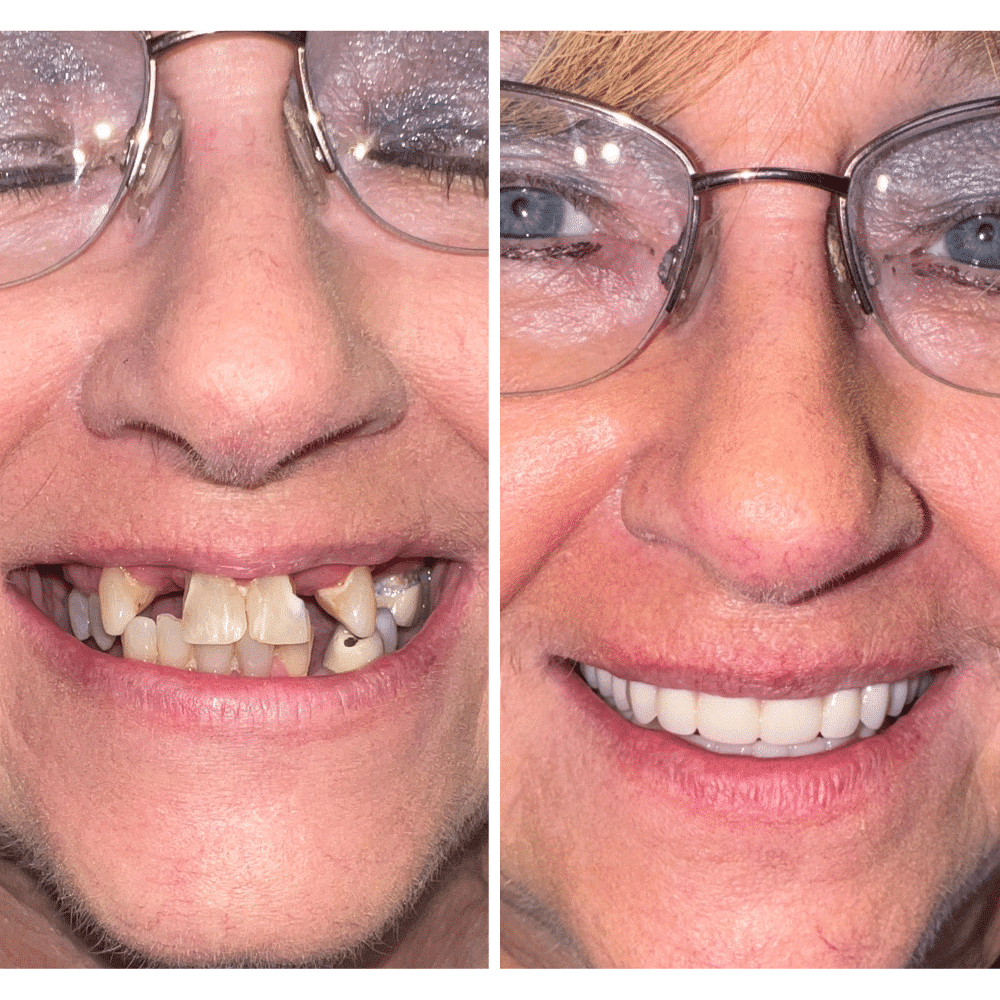 Before-and-After-Implants