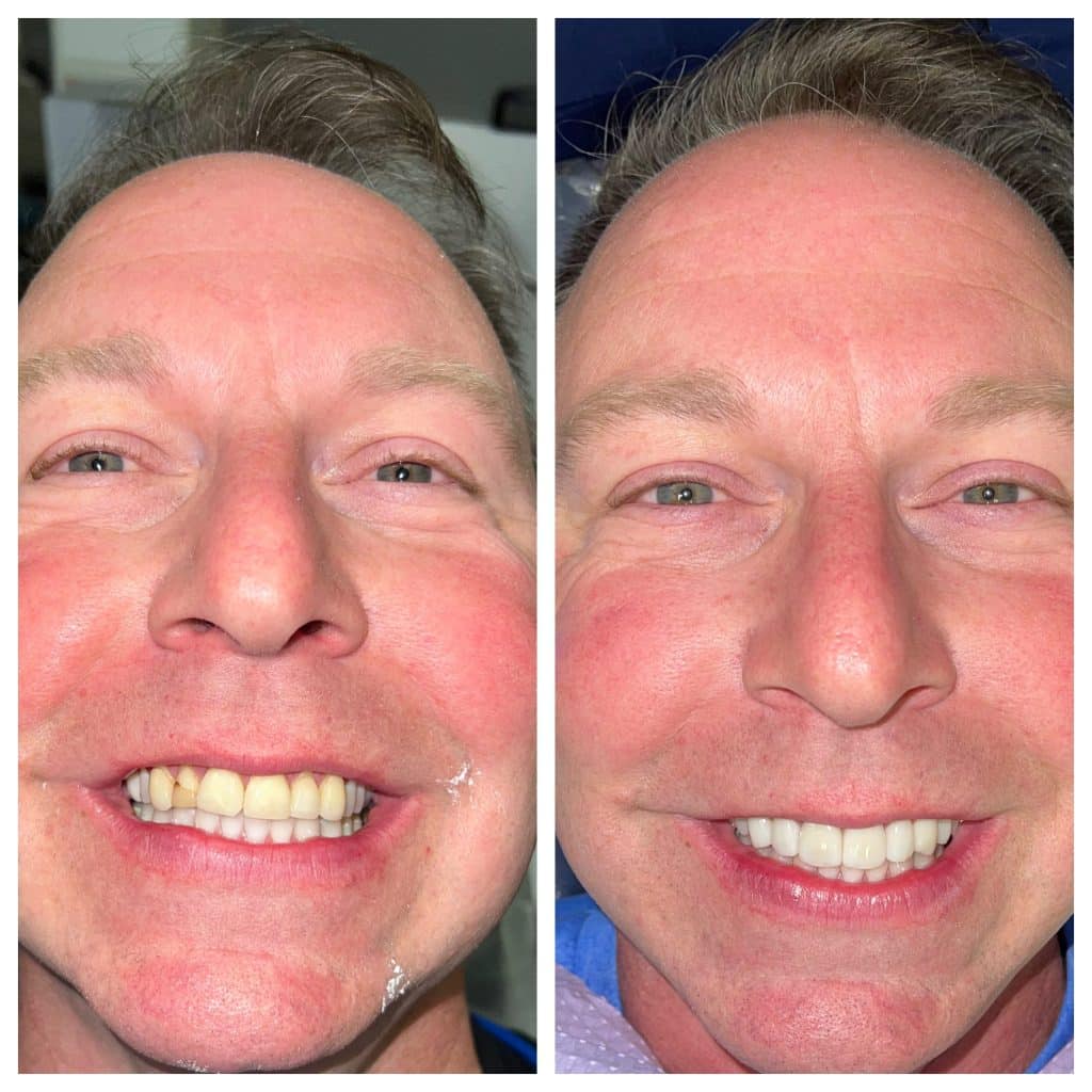 Before-and-After-Veneers