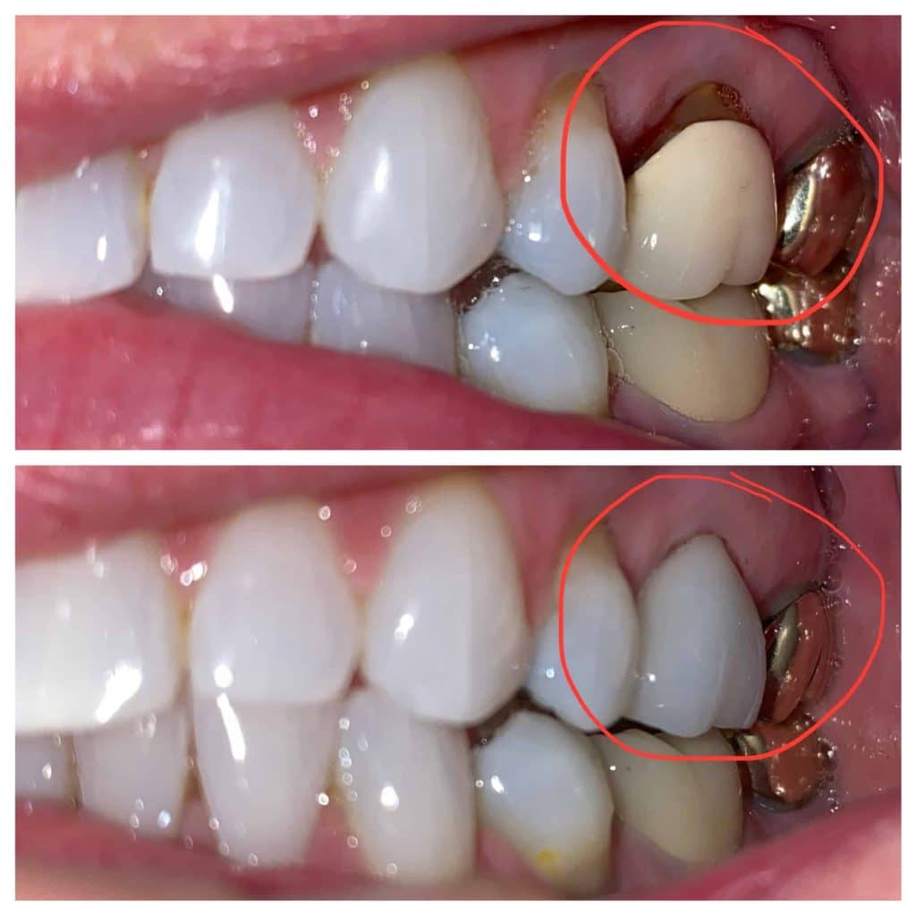 before and after dental crown