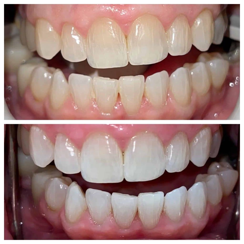 Whitening-Before-and-After
