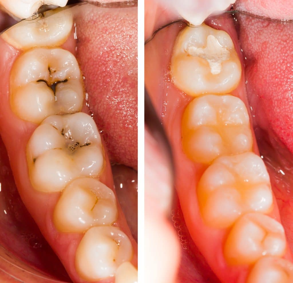 Before and after dental treatment - beforeafter series